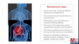 MesotheliomaA Rare Lung Cancer [upl. by Anaicilef]