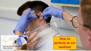 How to Perform an Ear Washout irrigation  ENTOtolaryngology Skills [upl. by Henri]