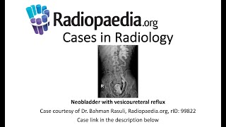 Neobladder with vesicoureteral reflux Radiopaediaorg Cases in Radiology [upl. by Chevalier]