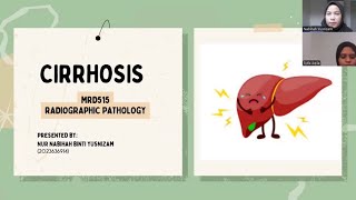 MRD515 VIDEO PRESENTATION CIRRHOSIS DISEASE [upl. by Astera]