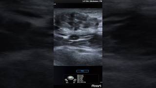 Cesarean scar endometriosis causing intermittent abdominal pain ultrasound ARDMS sonography [upl. by Battiste]