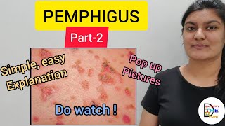 SKIN LESIONS PEMPHIGUS PART2 [upl. by Alford]