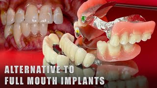 Alternative to Full Mouth Implants [upl. by Rew]