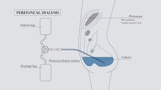 Understanding peritoneal dialysis [upl. by Anytsirhc]