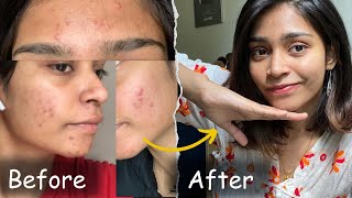 This Changed my life…  No product  No doctor  Acne journey Tamil [upl. by Llennej557]