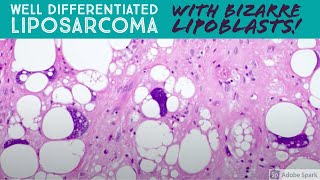 Well differentiated liposarcoma with BIZARRE pleomorphic lipoblasts 5Minute Pathology Pearls [upl. by Addiego634]