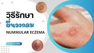 โรคผื่นวงกลม Nummular eczema เกิดจากอะไร รักษาอย่างไร  หมอยาพาคุย [upl. by Torrey189]