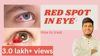 Blood spot in eye reasons How to treat blood spot in eye  Subconjunctival haemorrhage [upl. by Airdua681]