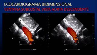 Generalidades de ecocardiograma doppler color [upl. by Saunders697]