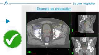 Radiothérapie  préparation pelvis [upl. by Jeremiah]