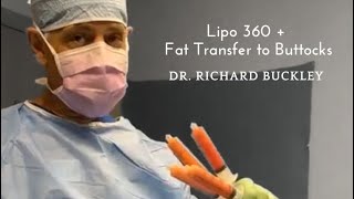 Liposuction 360  fat transfer to buttocks [upl. by Burack]