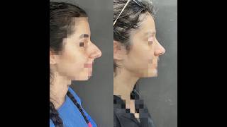 live Results before after for Rhinoplasty Surgery [upl. by Lluj41]