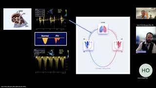 Right Ventricular Injury Patterns in Critical Care Cases [upl. by Htidirrem]