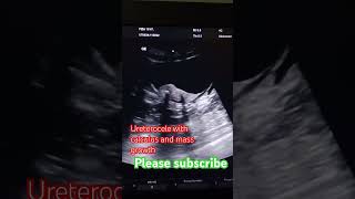 Urinary bladder scan Ureterocele with calculus and echogenic mass ultrasound usg ultrasoundscans [upl. by Suirauqed224]