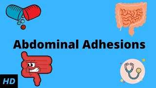 Abdominal Adhesions Causes Signs and Symptoms Diagnosis and Treatment [upl. by Manwell]