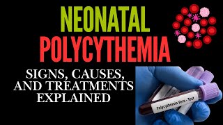 Neonatal Polycythemia Signs Causes and Treatments Explained [upl. by Esserac]