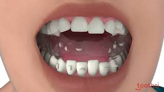 Toothsi Aligner Teeth Alignment Teeth Straightening  Teeth Gap Treatment [upl. by Grand540]