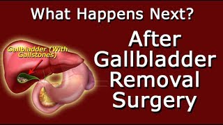 Youve Had Gallbladder Removal Surgery  What Happens Next [upl. by Enialed]