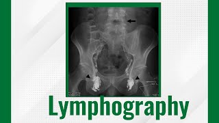 Lymphography Lymphangiography Techniques And Uses Lymphangiogram Purpose Procedure And Risks [upl. by Tann744]