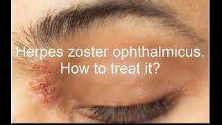 Herpes zoster ophthalmicus treatment  herpes zoster keratitis [upl. by Baumann547]