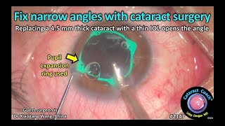 CataractCoach™ 2147 fix narrow angles with cataract surgery [upl. by Chere]