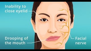 Symptoms Features and Presentations of Bells palsy [upl. by Van]