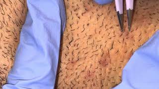 Ingrown Hairs Plucked from Beard [upl. by Suilienroc639]