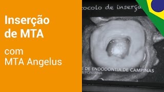 MTA Angelus  Protocolo de inserção do MTA [upl. by Keefe143]