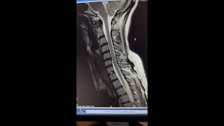 herniated disc [upl. by Oman]