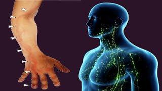 Lymphangitis Causes And Symptoms [upl. by Ahseral]