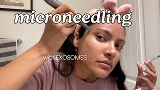 MICRONEEDLING MY FACE WITH EXOSOMES  Using Dr Pen amp Korean Salmon DNA [upl. by Arria]