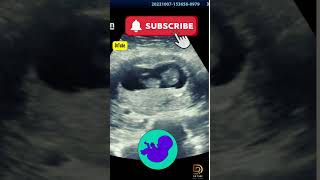 Fetal ultrasound of 10 weeks 6 days  Mother thinks its baby boy moving pregnancy ultrasound yt [upl. by Syl580]