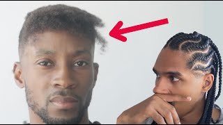 Fixing Receding Hairlines Fast  How to make Forehead Smaller Men [upl. by Trevar]