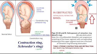 Obstetrics Contraction Constriction Ring Obstruction Pathological Retraction Ring Bandl difference [upl. by Nalrah]