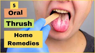 How To Treat Oral Thrush Oral Candidiasis Or Yeast Infection At Home  Best Home Remedies [upl. by Darleen786]