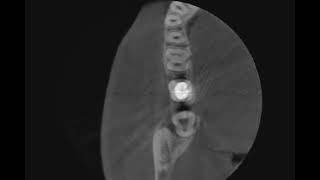 Alwaidh CBCT video [upl. by Chon]