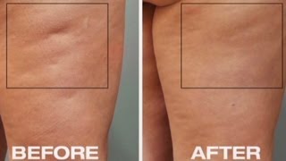 How to Get Rid of Cellulite Naturally  Non Surgical Cellulite Removal Tips FREE DOWNLOAD [upl. by Radmen]