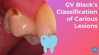 How to classify dental caries  GV Blacks Classification of Caries [upl. by Ardried295]