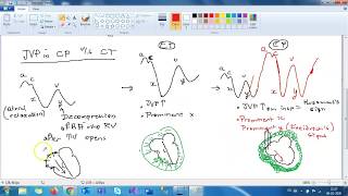 Constrictive pericarditis Etiology and presentation [upl. by Cooley]