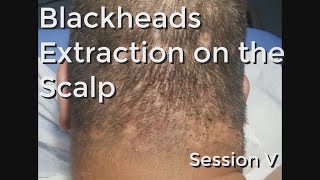 Blackheads Extraction on the Neck  Scalp  Session V [upl. by Nolra370]