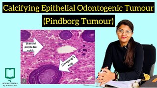 Calcifying Epithelial Odontogenic Tumour  Pindborg Tumour  CEOT  Lecture  21  Oral Pathology [upl. by Remmus]