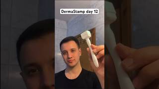 DermaStamp day 12Dermaroller nedir Saç çıkartır mı hair dermaroller dermastamp saç minoxidil [upl. by Akirdnahs]