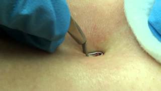 Getting rid of Back Acne Expert Extractions [upl. by Htebazileharas]