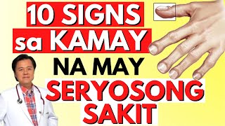 10 Signs sa Kamay na May Seryosong Sakit  Payo ni Doc Willie Ong [upl. by Anoyk]