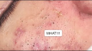 LOTS OF BLACKHEADS ON THE FACE 😨 GREAT JOB GA SPA PART II relaxing blackheads [upl. by Beulah]