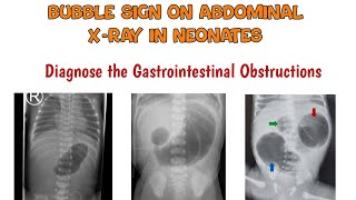 Signs in intestinal obstruction  Bubble signs on Abdominal xray  intestinal obstruction [upl. by Marilee776]