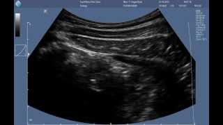 Abdominal RUSI ultrasound  correct contraction of the transversus abdominis [upl. by Ahsoym996]