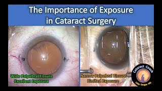 Surgical Exposure is Critical for Successful Cataract Surgery [upl. by Graehme]