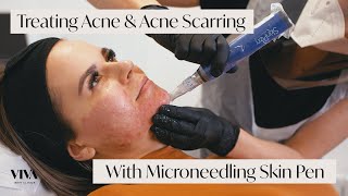 This Is Microneedling for Acne Scarring 🎯 [upl. by Gardia]