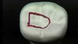 Endodontic Cavity Preparation  Phase I  Posterior [upl. by Nylisoj83]